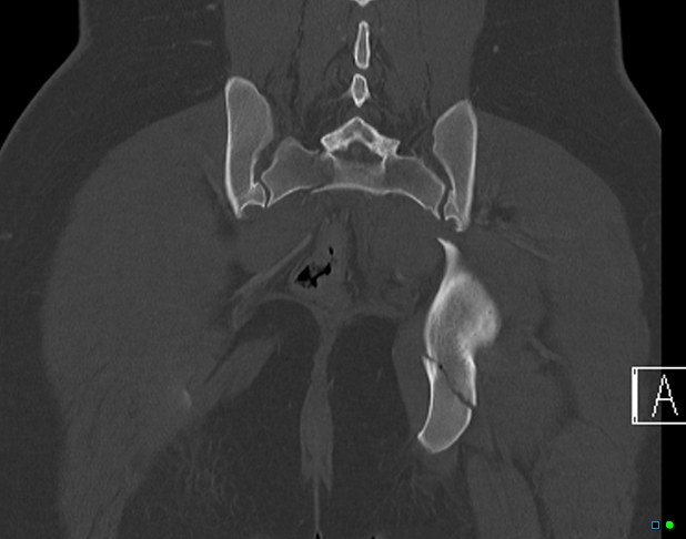 File:Bilateral acetabular fractures (Radiopaedia 79272-92308 Coronal bone window 34).jpg