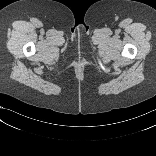 Bilateral acetabular protrusion with pincer type femoro-acetabular impingement (Radiopaedia 30134-30733 AXIAL SOFT THIN 120).jpg