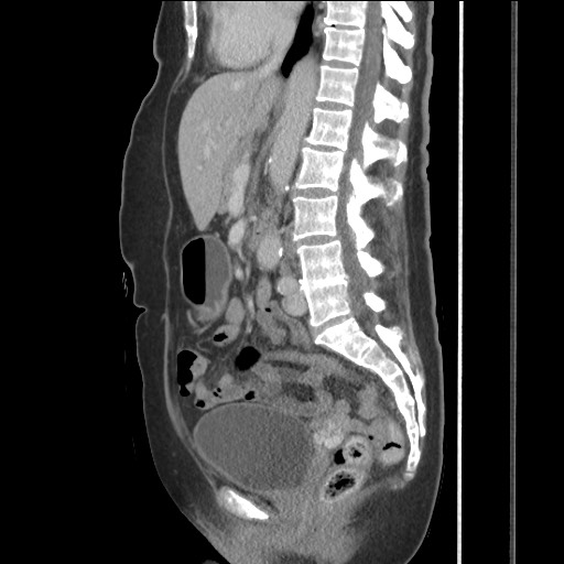 Bilateral adrenal granulocytic sarcomas (chloromas) (Radiopaedia 78375-91007 C 74).jpg