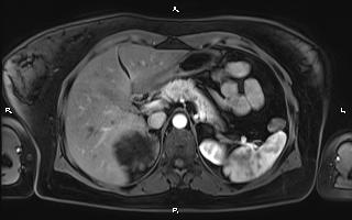 Bilateral adrenal myelolipoma (Radiopaedia 63058-71537 Axial T1 C+ fat sat 32).jpg