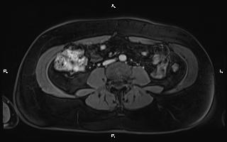Bilateral adrenal myelolipoma (Radiopaedia 63058-71537 G 69).jpg