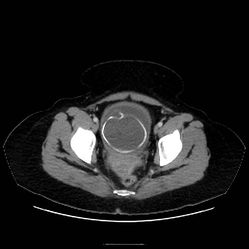 Bilateral adrenal thrombosis (Radiopaedia 58182-65256 A 71).jpg