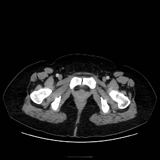 Bilateral adrenal thrombosis (Radiopaedia 58182-65256 A 80).jpg