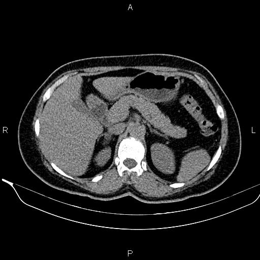 Bilateral benign adrenal adenomas (Radiopaedia 86912-103124 Axial non-contrast 37).jpg
