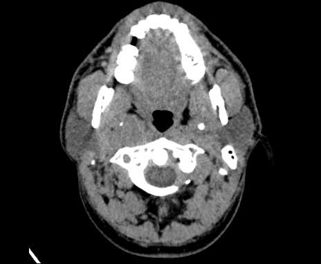 Bilateral carotid body tumors (Radiopaedia 61841-69870 Axial non-contrast 22).jpg