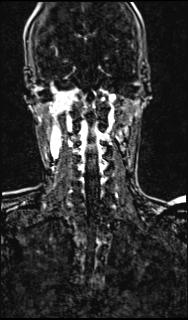 Bilateral carotid body tumors and right glomus jugulare tumor (Radiopaedia 20024-20060 MRA 116).jpg