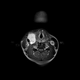 File:Bilateral carotid body tumors and right jugular paraganglioma (Radiopaedia 20024-20060 Axial 94).jpg