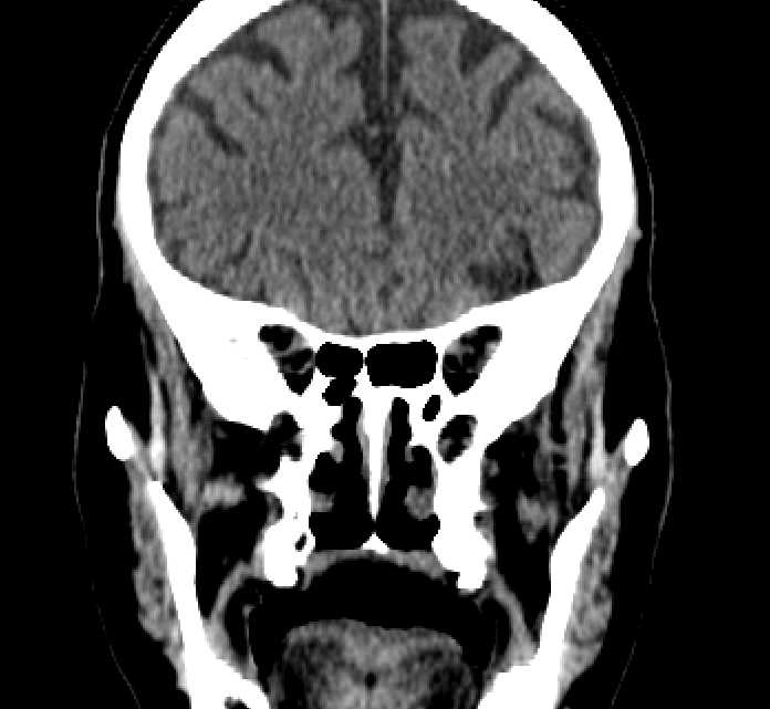 Bilateral ectopia lentis (Radiopaedia 89889-107013 Coronal non-contrast 95).jpg