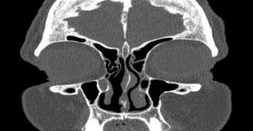 File:Bilateral ectopic infraorbital nerves (Radiopaedia 49006-54084 Coronal 57).png