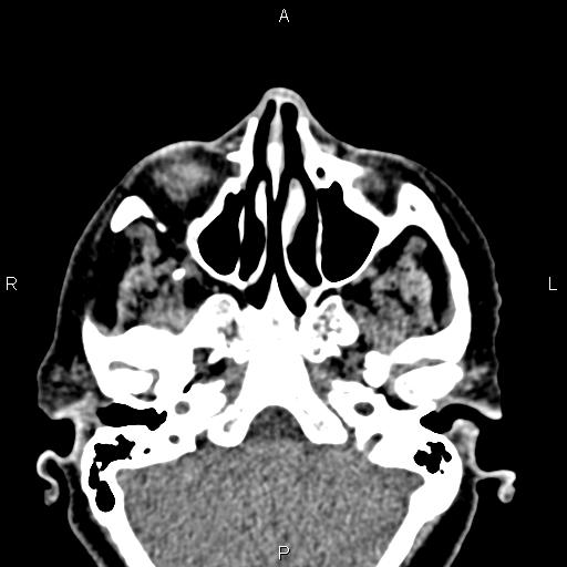 File:Bilateral enlargement of lacrimal glands - sarcoidosis (Radiopaedia 62627-70921 Axial non-contrast 23).jpg