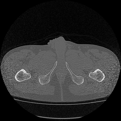 Bilateral femoral neck stress fractures (Radiopaedia 28666-28954 Axial bone window 88).png