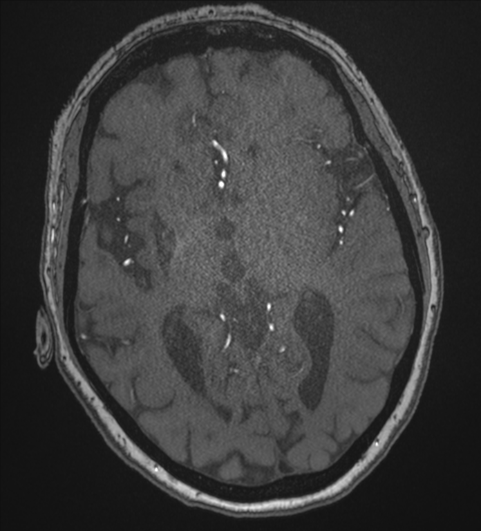 Bilateral fetal posterior communicating arteries (Radiopaedia 41286-44102 Axial MRA 110).png