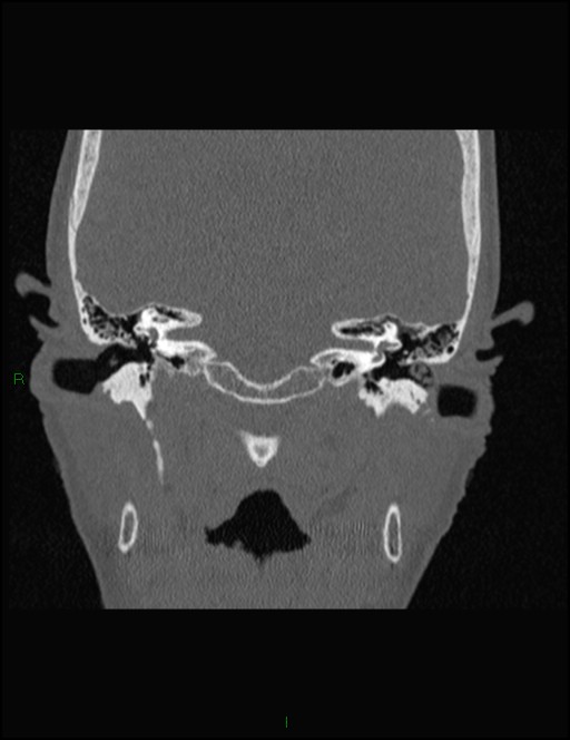 Bilateral frontal mucoceles (Radiopaedia 82352-96454 Coronal 306).jpg