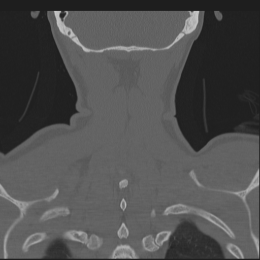 Bilateral locked facets (Radiopaedia 33850-35016 Coronal bone window 78).png