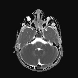 File:Bilateral mesial temporal polymicrogyria (Radiopaedia 76456-88181 Axial ADC 6).jpg