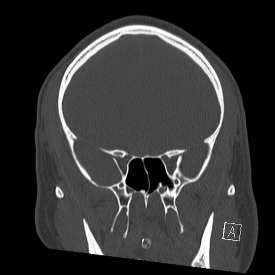 Bilateral occipital condyle fracture (type 2) (Radiopaedia 87675-104089 Coronal bone window 37).jpg