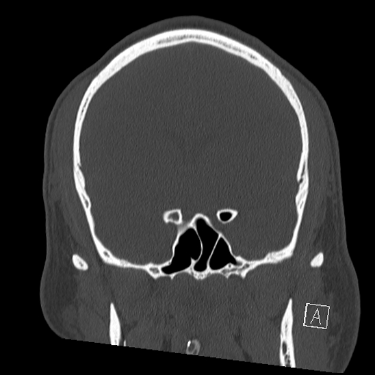 Bilateral occipital condyle fracture (type 2) (Radiopaedia 87675-104089 Coronal bone window 47).jpg