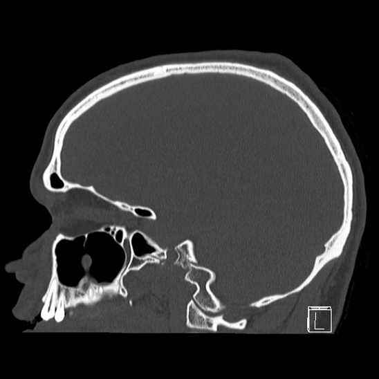 Bilateral occipital condyle fracture (type 2) (Radiopaedia 87675-104089 Sagittal bone window 70).jpg