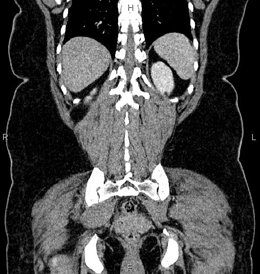 Bilateral ovarian dermoid cysts (Radiopaedia 85785-101603 C 49).jpg