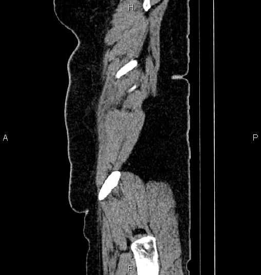 Bilateral ovarian dermoid cysts (Radiopaedia 85785-101603 D 94).jpg