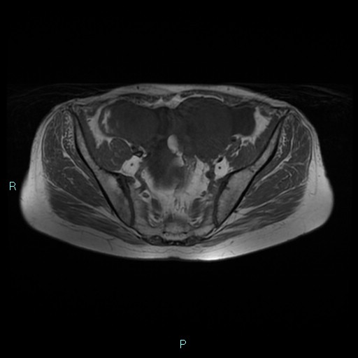 File:Bilateral ovarian fibroma (Radiopaedia 44568-48293 Axial T1 10).jpg