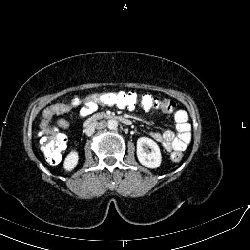 Bilateral ovarian serous cystadenocarcinoma (Radiopaedia 86062-101989 B 46).jpg