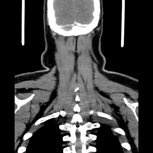 File:Bilateral peritonsillar abscess (Radiopaedia 85065-100610 Coronal 65).jpg