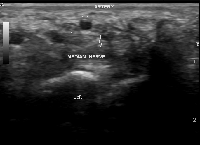 File:Bilateral persistent median artery of the forearm with unilateral bifid median nerve (Radiopaedia 17430-17121 B 1).jpg
