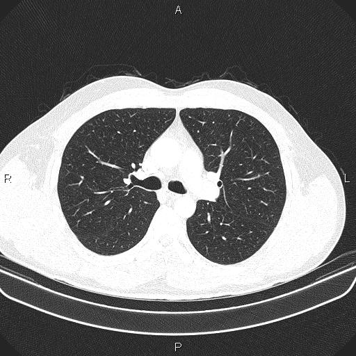 File:Bilateral pulmonary AVM (Radiopaedia 83134-97505 Axial lung window 29).jpg
