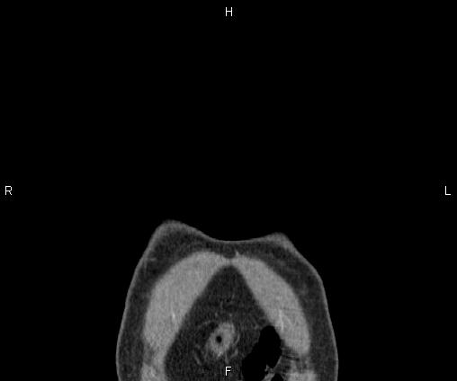 Bilateral pulmonary AVM (Radiopaedia 83134-97505 C 1).jpg