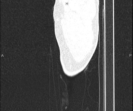 Bilateral pulmonary AVM (Radiopaedia 83134-97505 Sagittal lung window 115).jpg
