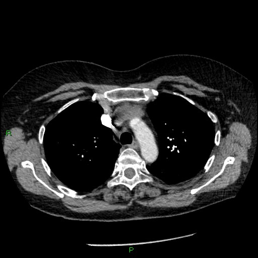 File:Bilateral pulmonary emboli (Radiopaedia 32700-33669 Axial C+ CTPA 32).jpg