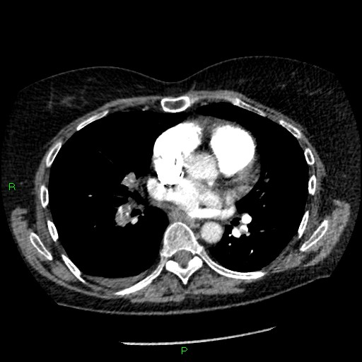 Bilateral pulmonary emboli (Radiopaedia 32700-33669 Axial C+ CTPA 58).jpg