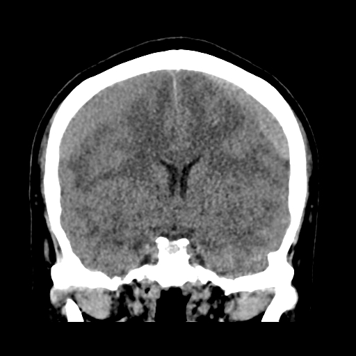 Bilateral subacute subdural hematoma (Radiopaedia 69240-79018 Coronal non-contrast 26).jpg