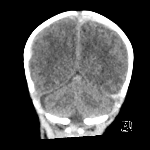 File:Bilateral subdural hemorrhage and parietal skull fracture (Radiopaedia 26058-26192 Coronal non-contrast 21).png