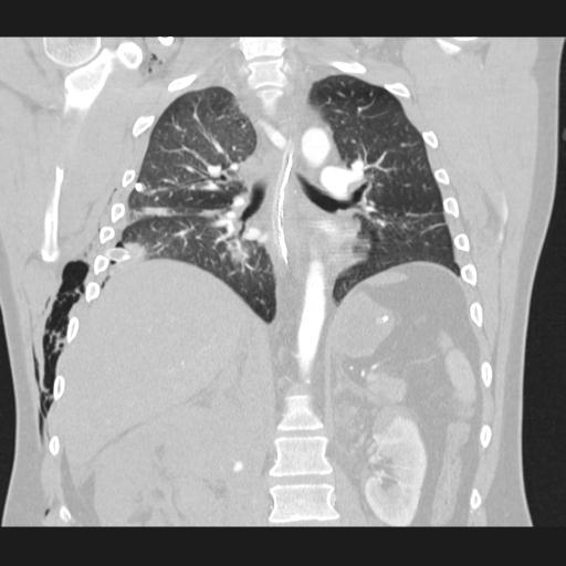 Bilateral traumatic renovascular injury (Radiopaedia 32051-32995 Coronal lung window 49).jpg