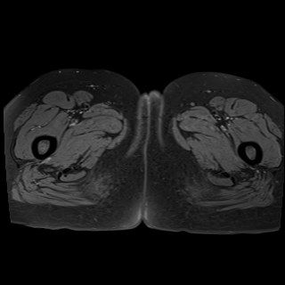 Bilateral tubo-ovarian abscesses (Radiopaedia 58635-65829 Axial T1 fat sat 55).jpg