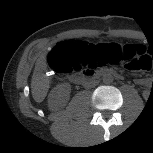 File:Bile leak from liver traumatic laceration (Radiopaedia 63463-72077 Axial Biliscopin 73).jpg