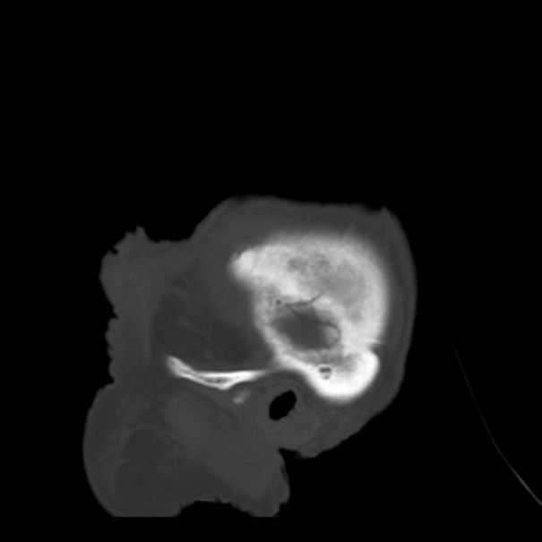 Biparietal osteodystrophy (Radiopaedia 46109-50463 Sagittal bone window 98).jpg