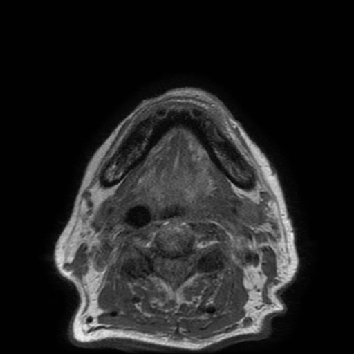 Bisphosphonate-related osteonecrosis of the maxilla (Radiopaedia 51367-57101 Axial T1 6).jpg