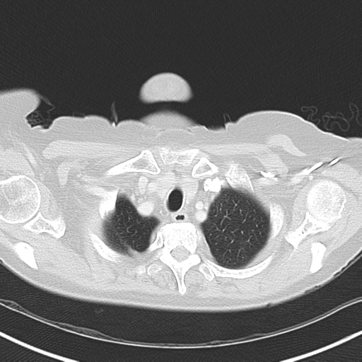 File:Bladder and bowel cancers (Radiopaedia 37688-39592 Axial lung window 7).png