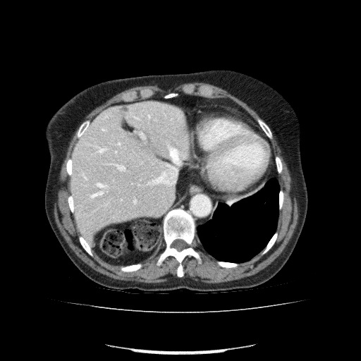 File:Bladder tumor detected on trauma CT (Radiopaedia 51809-57609 B 24).jpg