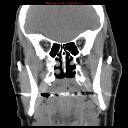File:Blowout fracture with inferior rectus entrapment (Radiopaedia 12418-12673 Coronal non-contrast 18).jpg