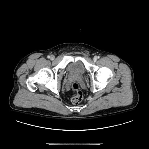 Blunt abdominal trauma with solid organ and musculoskelatal injury with active extravasation (Radiopaedia 68364-77895 A 149).jpg
