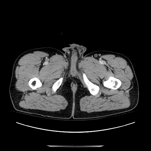 Blunt abdominal trauma with solid organ and musculoskelatal injury with active extravasation (Radiopaedia 68364-77895 A 174).jpg