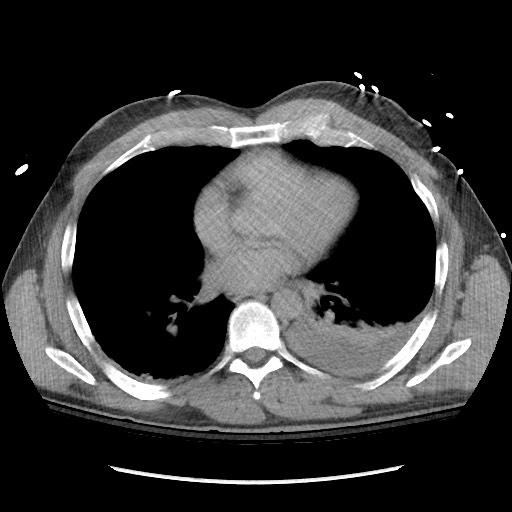 Blunt abdominal trauma with solid organ and musculoskelatal injury with active extravasation (Radiopaedia 68364-77895 Axial C+ delayed 1).jpg