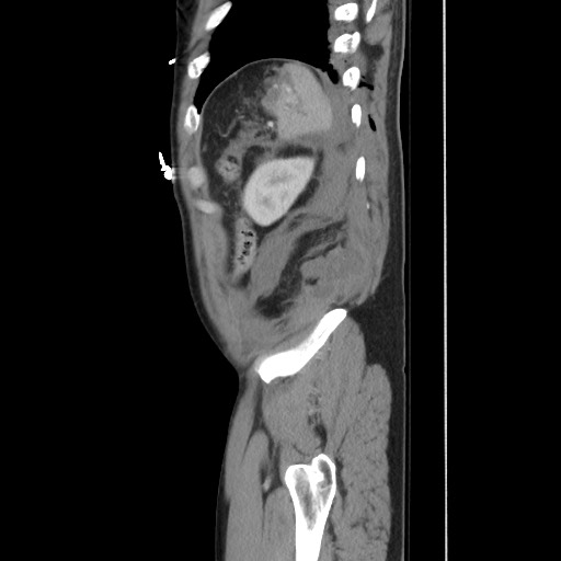 Blunt abdominal trauma with solid organ and musculoskelatal injury with active extravasation (Radiopaedia 68364-77895 C 121).jpg