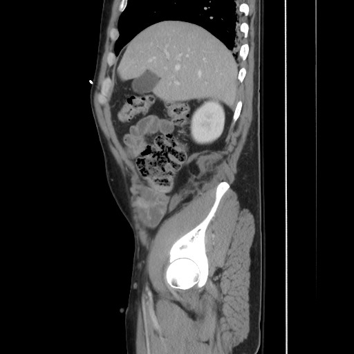 File:Blunt abdominal trauma with solid organ and musculoskelatal injury with active extravasation (Radiopaedia 68364-77895 C 43).jpg