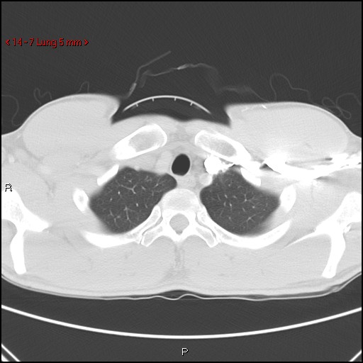 File:Blunt chest trauma - pulmonary interstitial emphysema and pneumomediastinum (Radiopaedia 20666-20552 Axial lung window 7).jpg