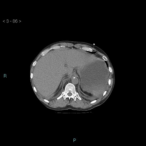 Boerhaave syndrome (Radiopaedia 27683-27897 Axial non-contrast 86).jpg